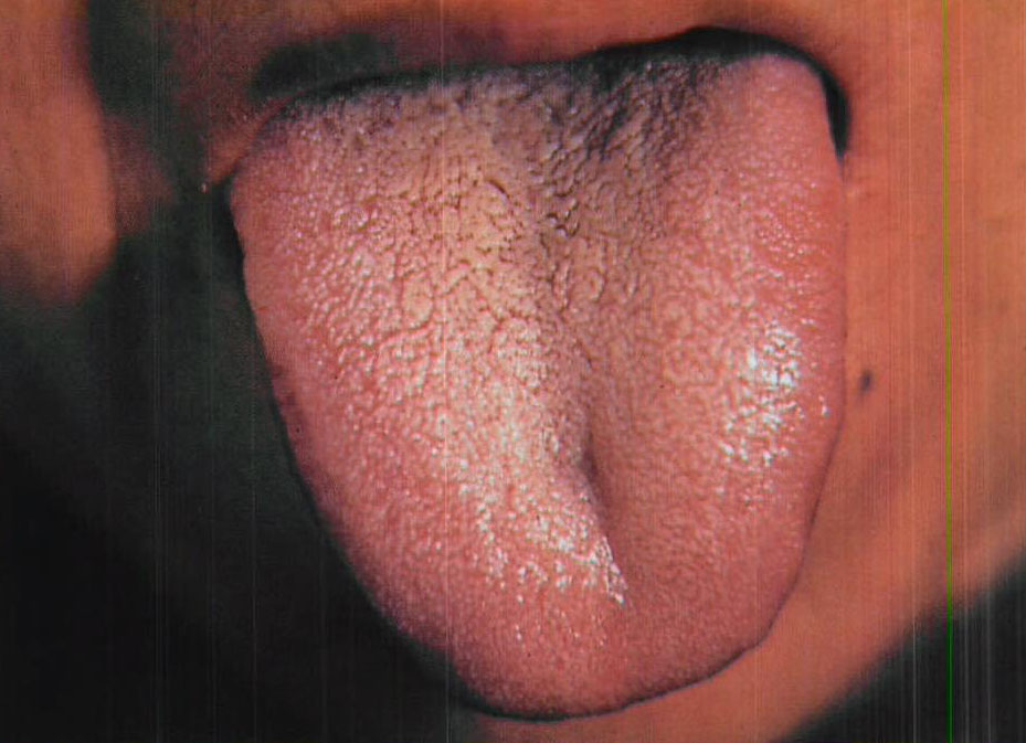 痰熱挾瘀
